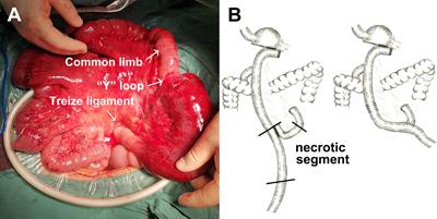Risk Factor and <mark class="highlighted">Surgical Outcome</mark> of Petersen’s Hernia After Gastrectomy in Gastric Cancer